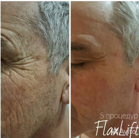 FlaxLift Обучение косметолог. уход. процедуре