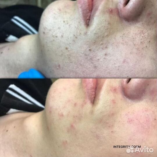 Чистка лица, спины механическая, комбинированная