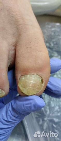 Обработка вросших ногтей и онихолизиса