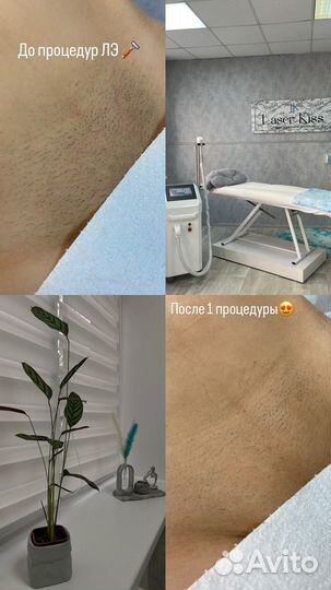 Лазерная эпиляция диодный лазер