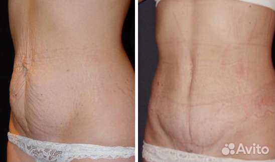 Кавитация, мега комплекс -5 кг Янино