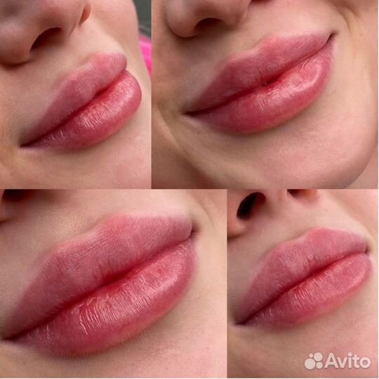 Увеличение губ Контурная пластика фулфейс