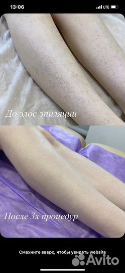 Элос эпиляция