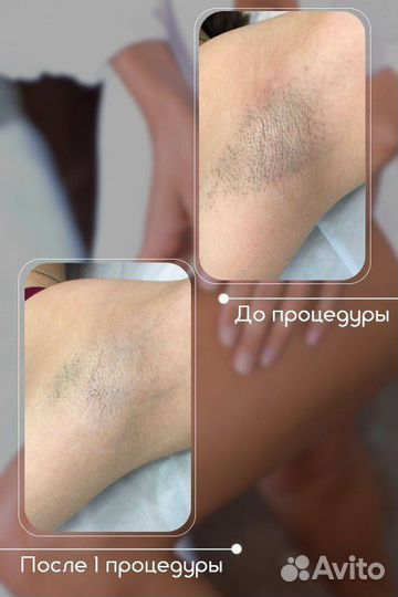 Студия лазерной эпиляции