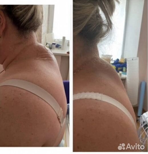 Криолиполиз,lpg массаж, кавитация,RF лифтинг