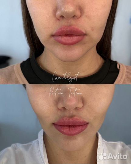 Нужны модели на липолитики