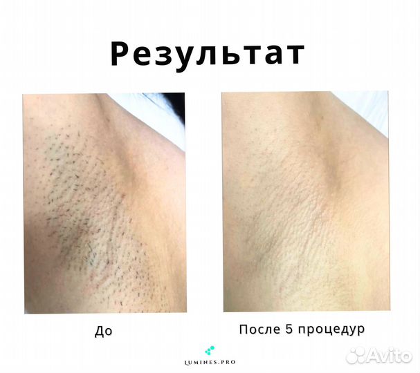 Диодный лазер для эпиляции Lumines’ Макс’Ван 1200W