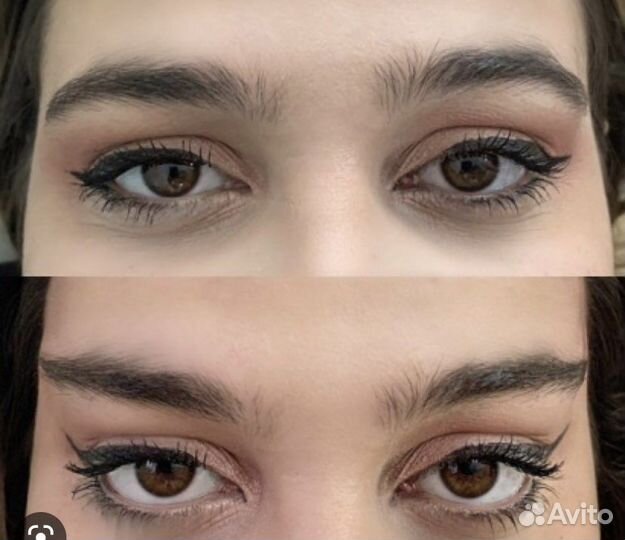 Тейпы от нависших век и подбородка