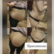 Криолиполиз похудение, Майкоп