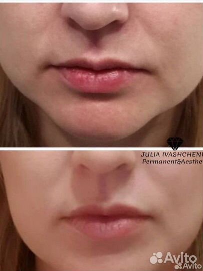 Омоложение