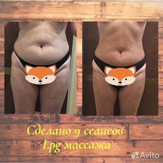 Массаж LPG