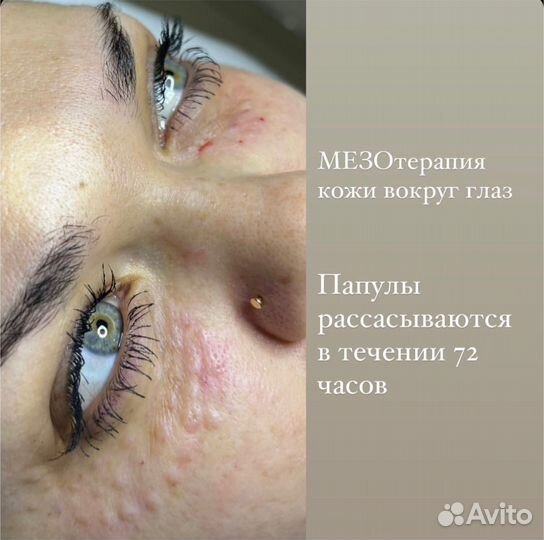 Увеличение губ, ботокс, мезотерапия