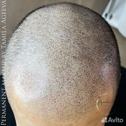 Трихопигментация, камуфляж шрамов и ожогов