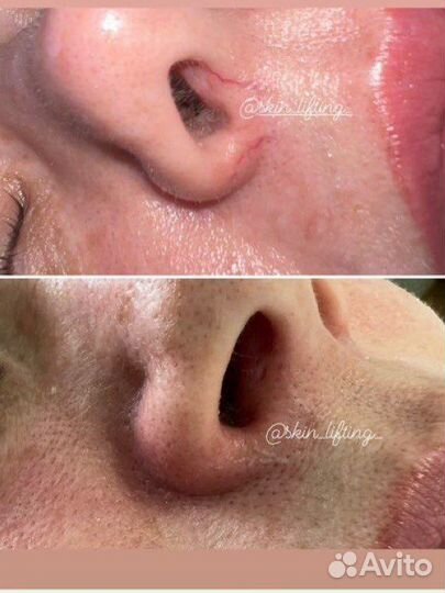 Сосуды/Купероз/Лицо/Тело