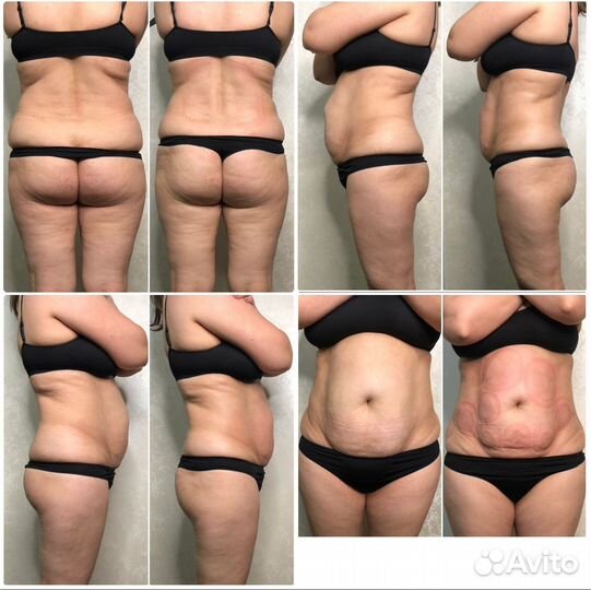 Коррекция фигуры Массаж ручной