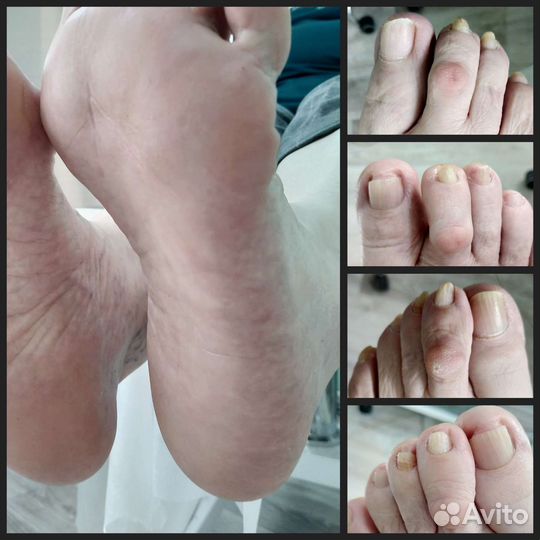 Подолог. Гигиенический педикюр