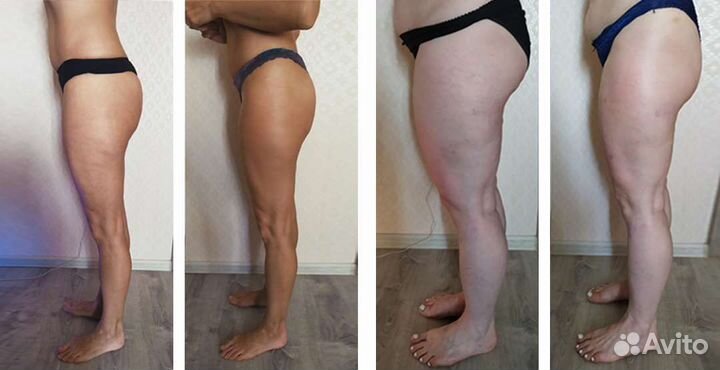 Вакуумный массаж/ Кавитация/ Биофотон/ Вибромассаж