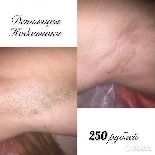 Депиляция воском: бёдра