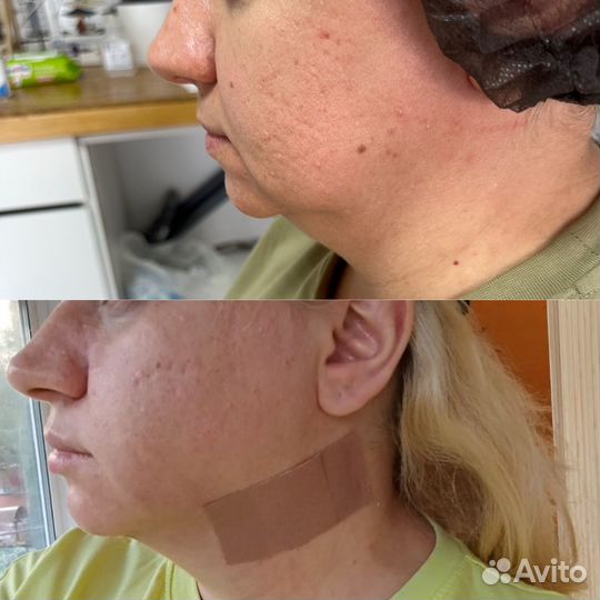 Липосакция подбородка. Увеличение губ. Ботокс