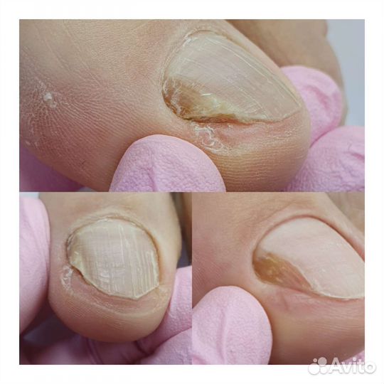 Лечебный педикюр подолог