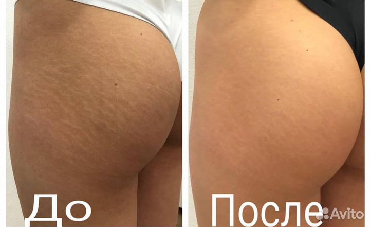 Удаление растяжек живот