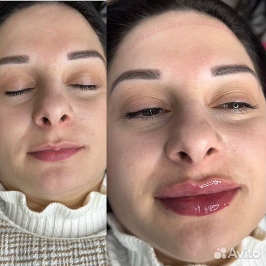 Увеличение губ