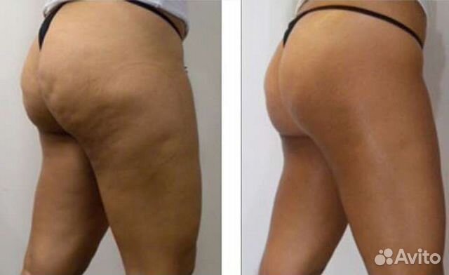 Вакуумный массаж, кавитация