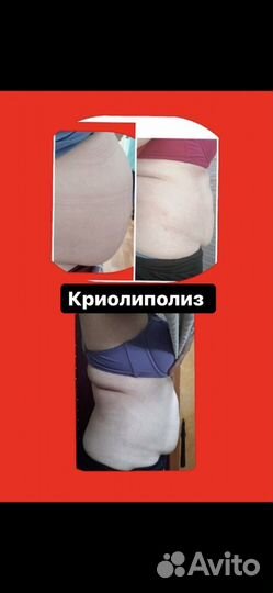 Обучение аппаратному массажу