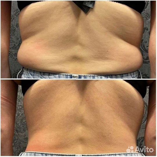 Вакуумный массаж/ Кавитация/ Биофотон/ Вибромассаж