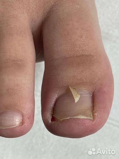 Медицинский педикюр. Подолог