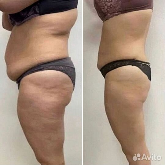 Аппаратный массаж /снижение веса, коррекция фигуры