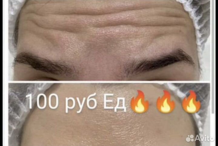 Ботокс для лица