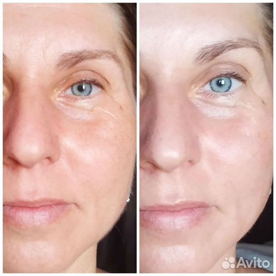 Скульптурно-буккальный массаж лица