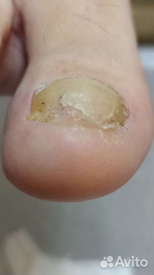 Медицинский педикюр, педикюр