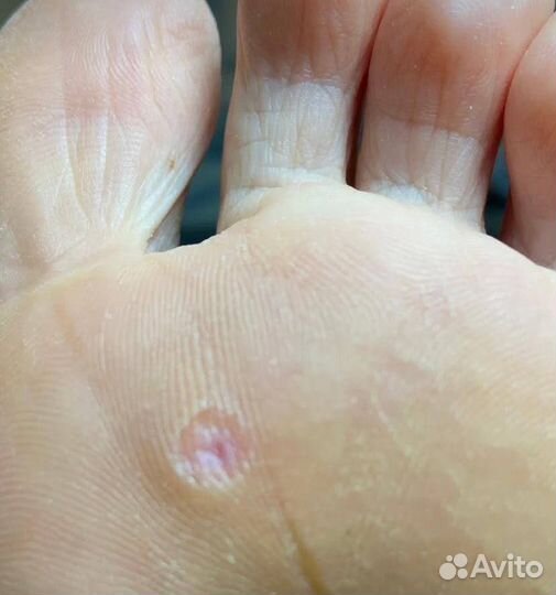 Удаление мозолей, бородавок, подолог