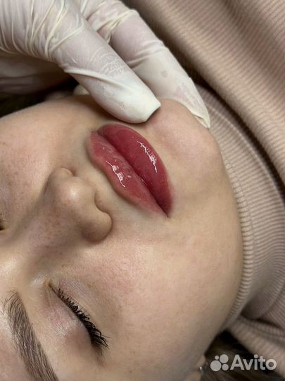 Косметолог. Увеличение губ. Ботокс