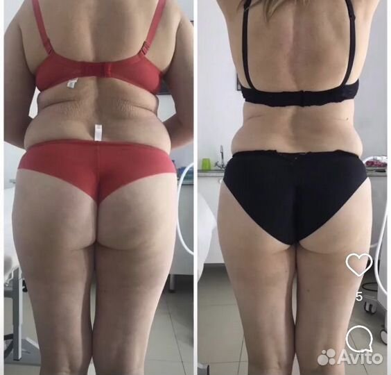 Коррекция фигуры (сфератерапия,EMC, криолиполиз)