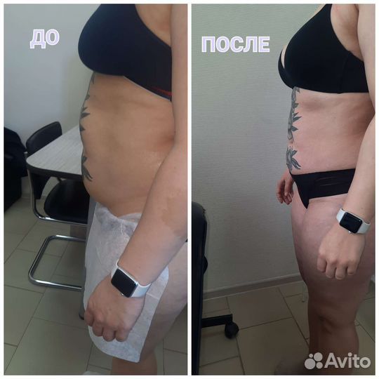 Вакуумный массаж, кавитация,RF- лифтинг,депиляция