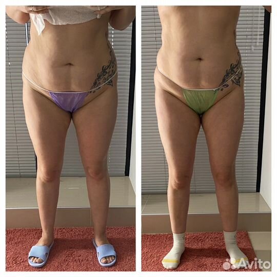 Карамельная липосакция.Аппаратный массаж