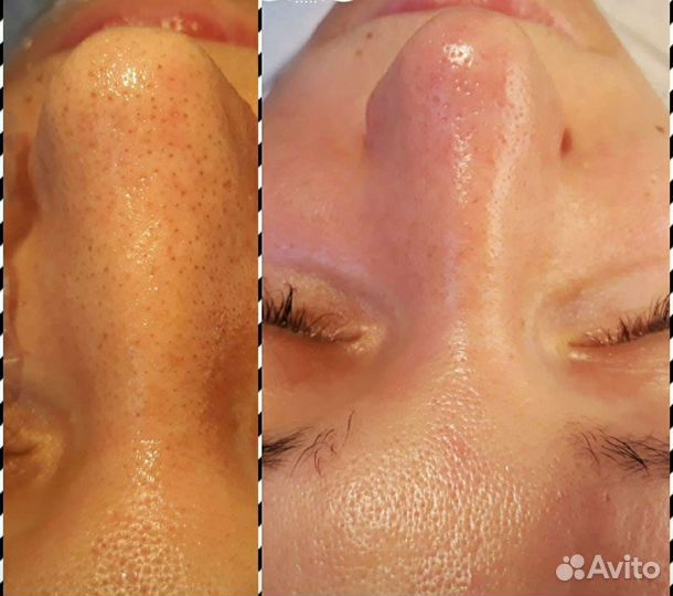 Пилинг лица ретинолом