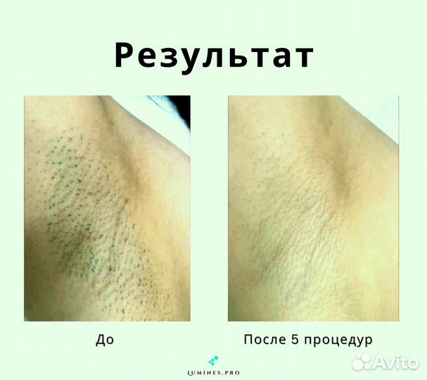 Диодный лазер Lumines. Max One 1200W