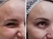 Ботулотоксин/Ботокс(botox) /Ботулинотерапия