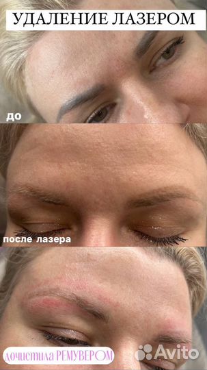 Удаление татуажа,тату лазером,ремувером