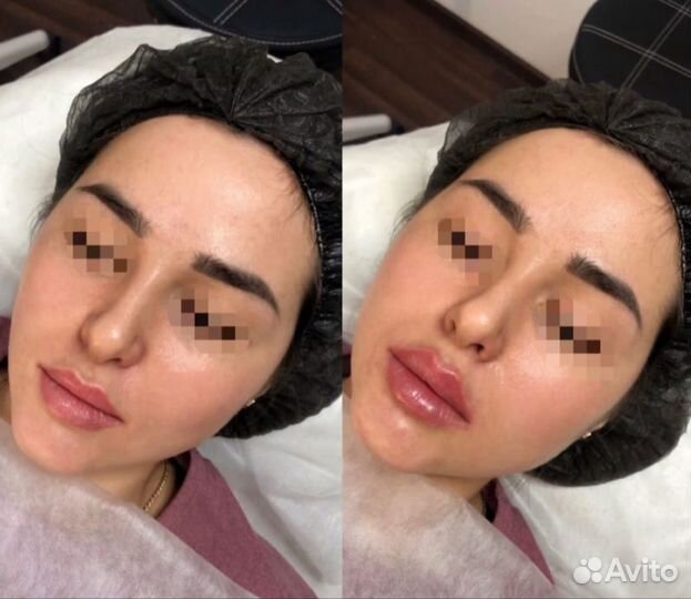 Увеличение губ