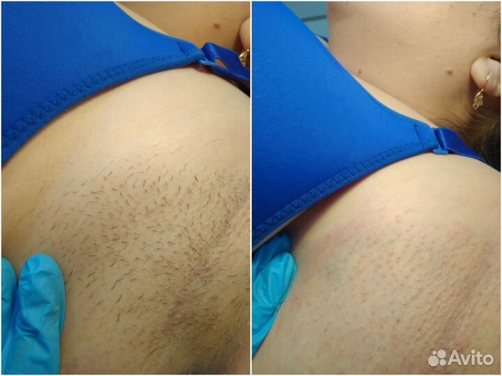 Электроэпиляция