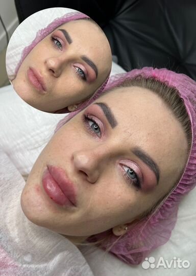 Увеличение губ