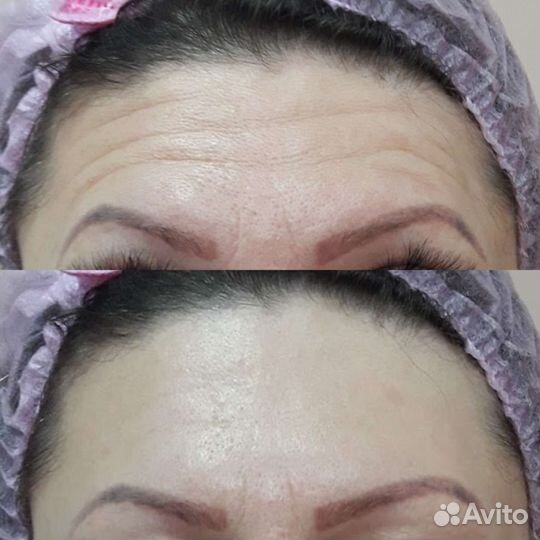 Косметолог, ботокс, био, мезо