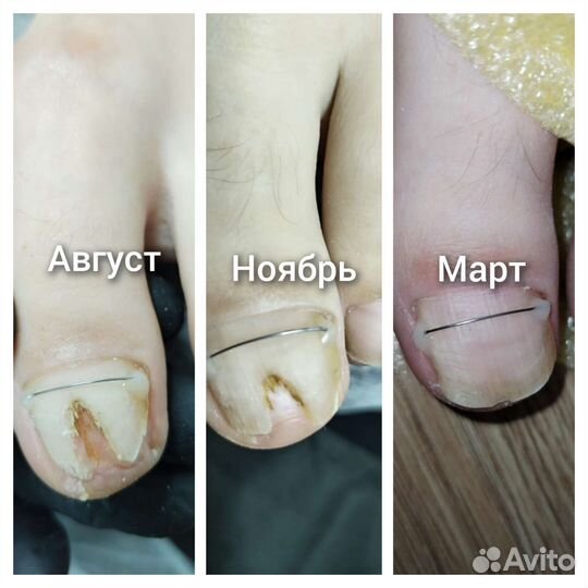 Подолог, Педикюр гель лак,Вросший ногть,грибок