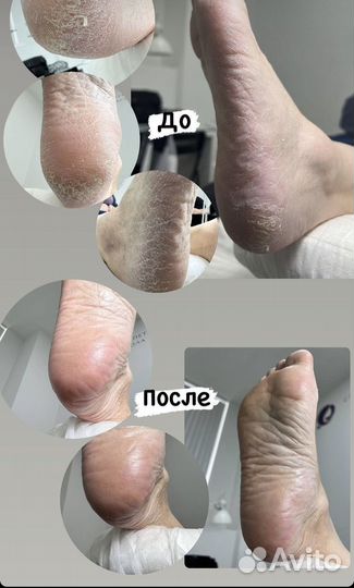 Смарт педикюр