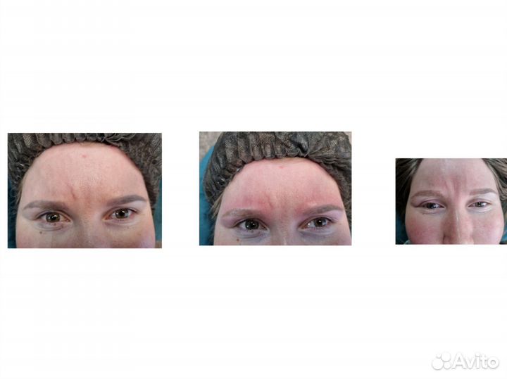 Удаление татуажа